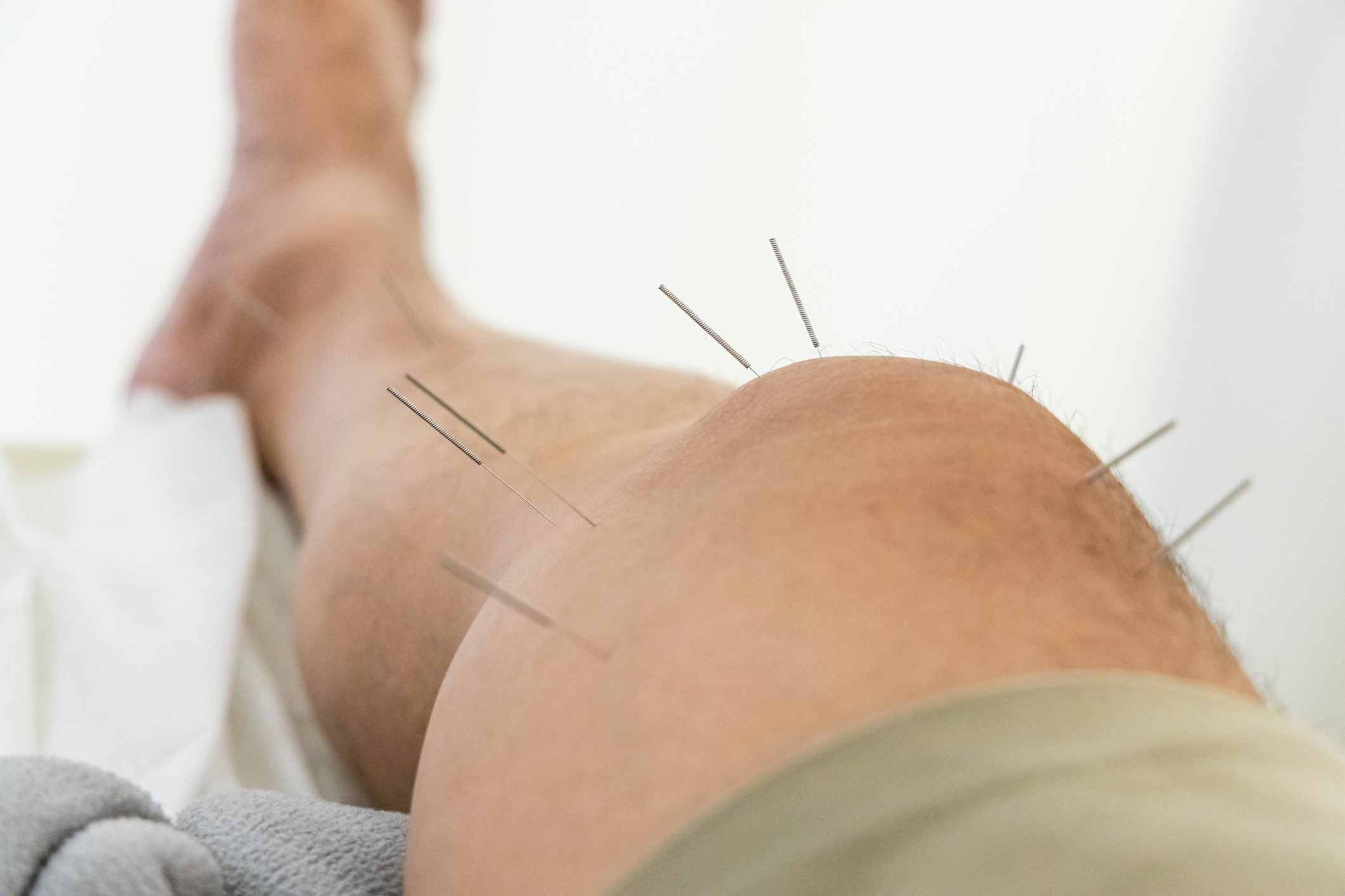 Acupunctuur | Fysiotherapie Culemborg